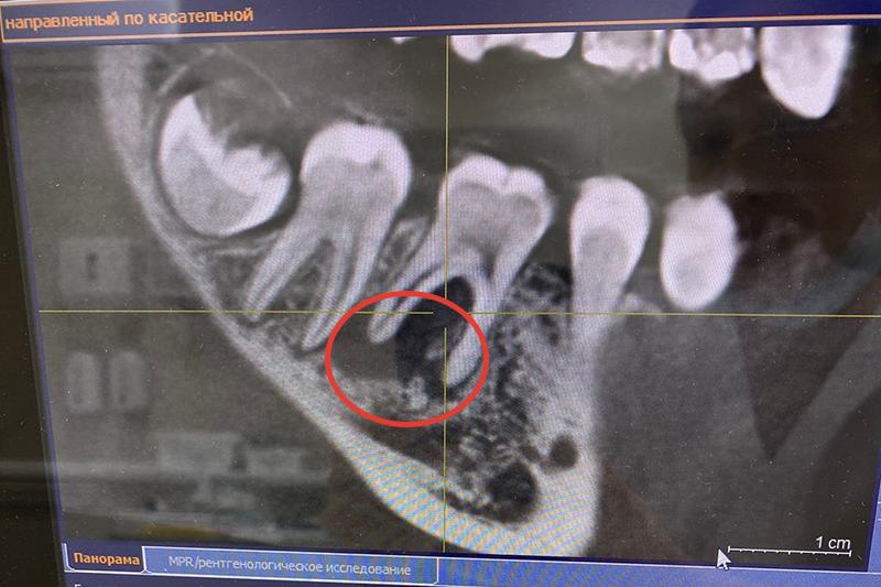 зуб с хроническим гранулирующим периодонтитом до лечениф.jpg